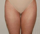 Bella Contour patient before photo