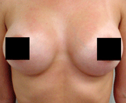 Breast Augmentation patient after photo