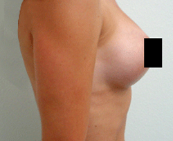 Breast Augmentation patient after photo