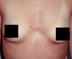 Breast Augmentation patient before photo