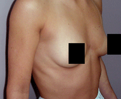 Breast Augmentation patient before photo