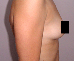 Breast Augmentation patient before photo