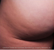 Cellulite patient after photo