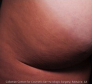 Cellulite patient after photo
