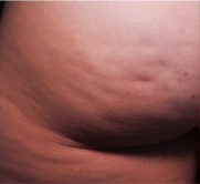 Cellulite patient before photo