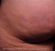 Cellulite patient before photo
