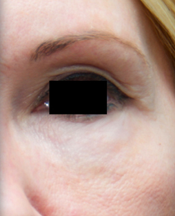Microneedling patient after photo