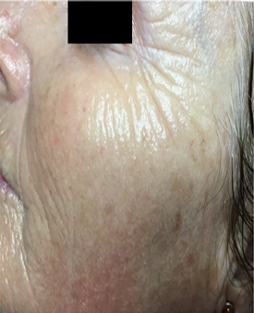 Microneedling  patient after photo