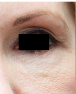 Microneedling patient before photo