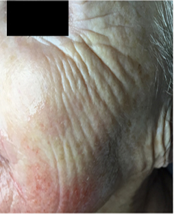 Microneedling patient before photo