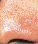 Facial Vein Treatment patient after photo
