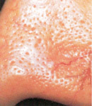 Facial Vein Treatment patient before photo