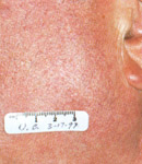 Facial Vein Treatment patient after photo
