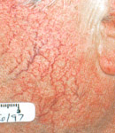 Facial Vein Treatment patient before photo