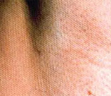 Laser Hair Removal patient after photo