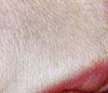 Laser Hair Removal patient after photo