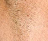 Laser Hair Removal patient before photo
