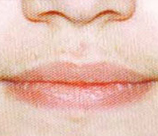 Laser Hair Removal patient before photo