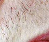 Laser Hair Removal patient before photo