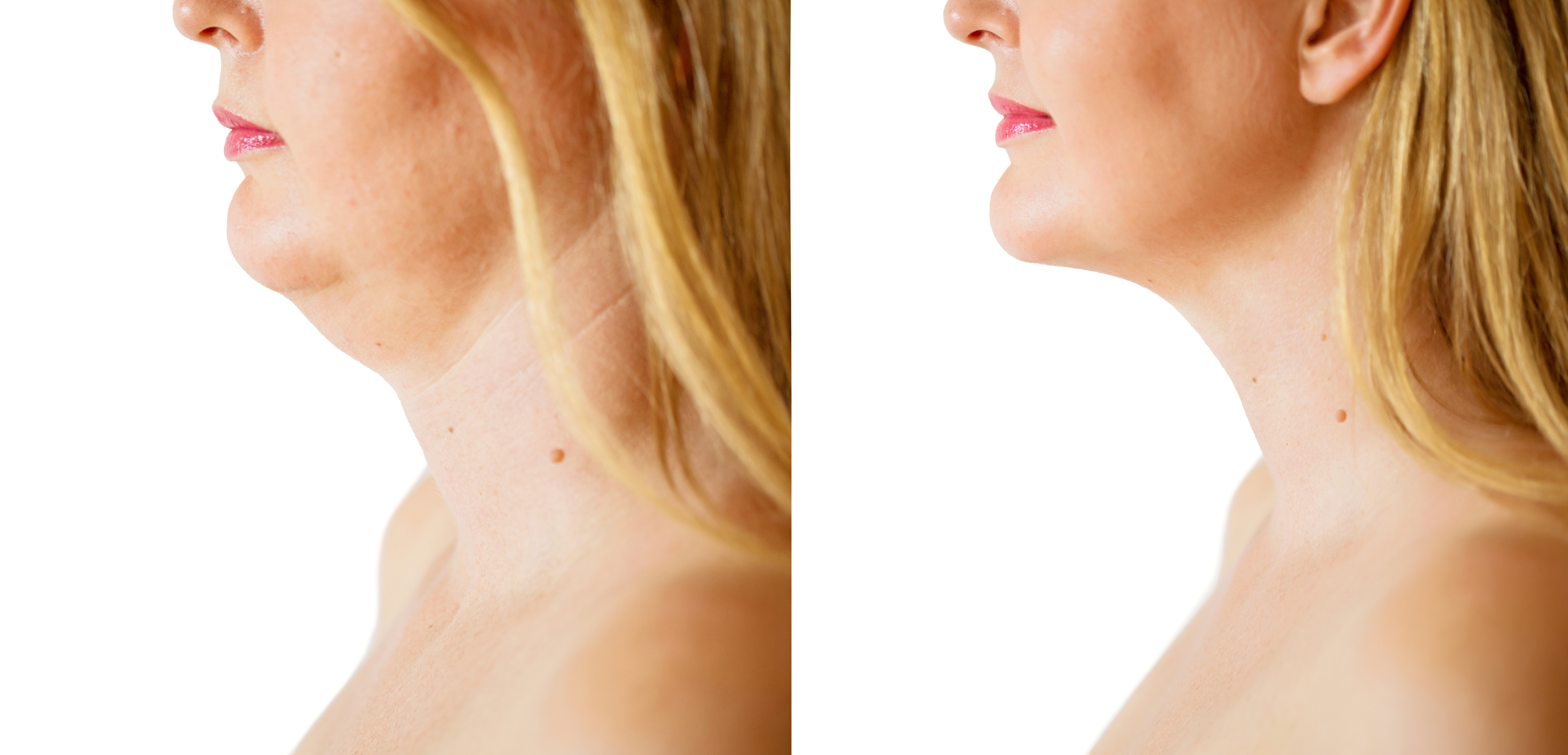 Kybella Service Photo3