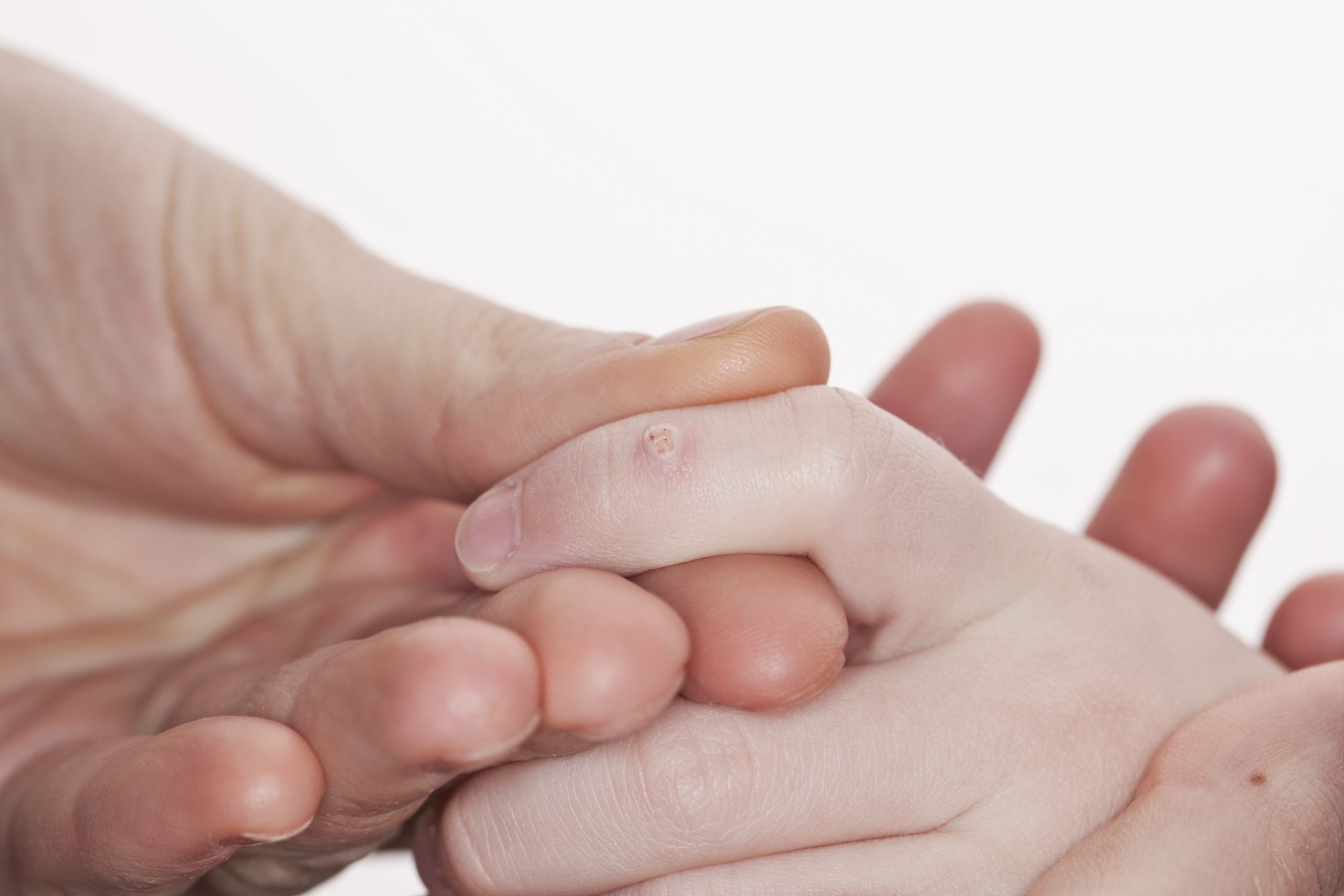 Warts Service Photo5
