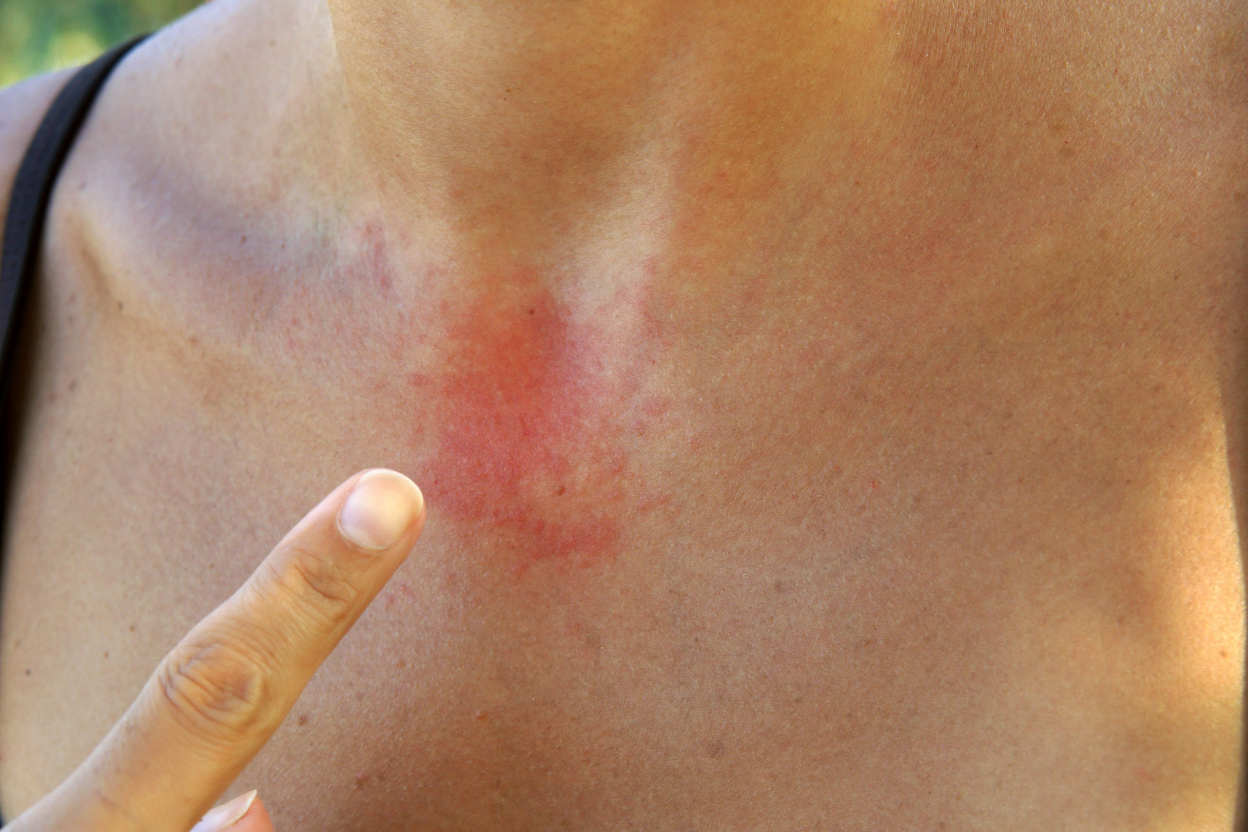 Eczema Service Photo4