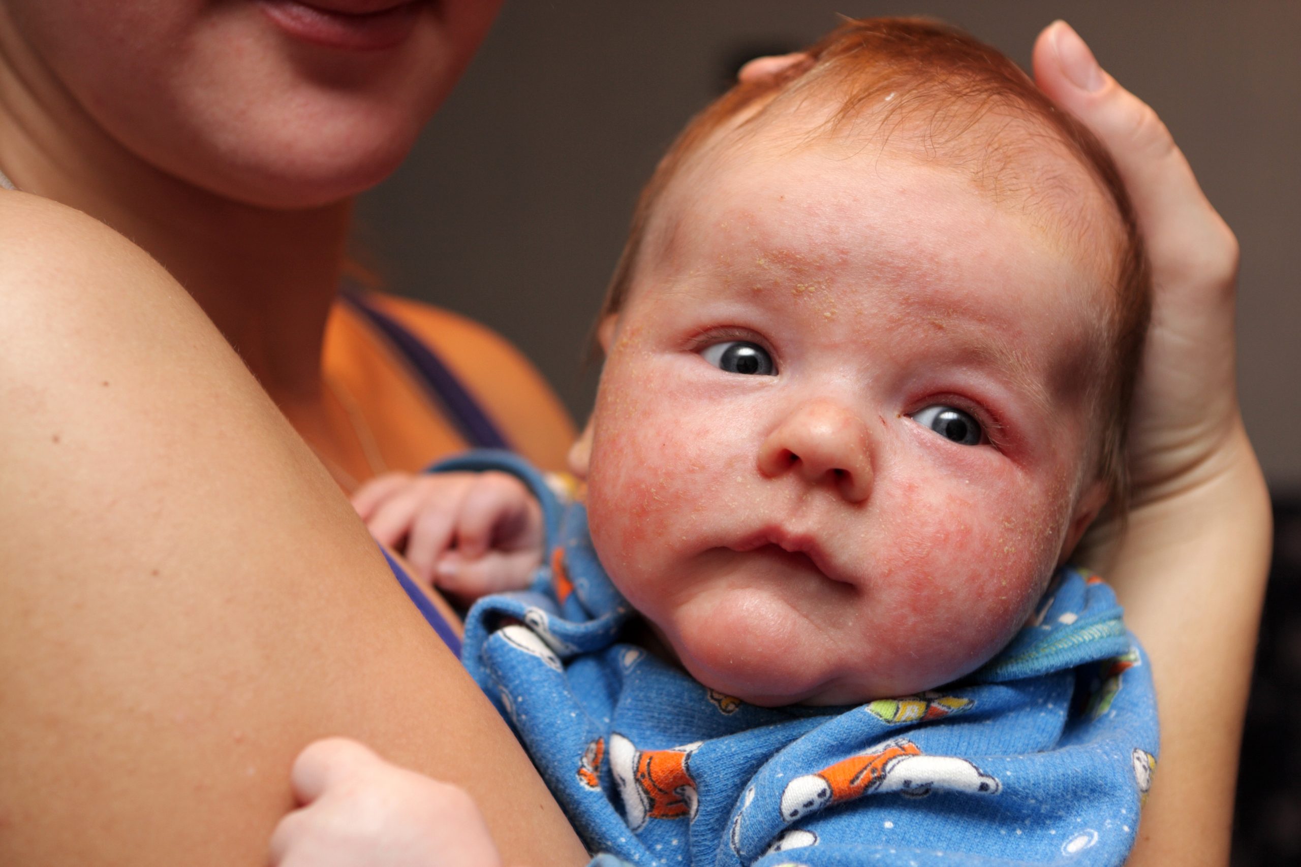 Diaper Rash Service Photo4