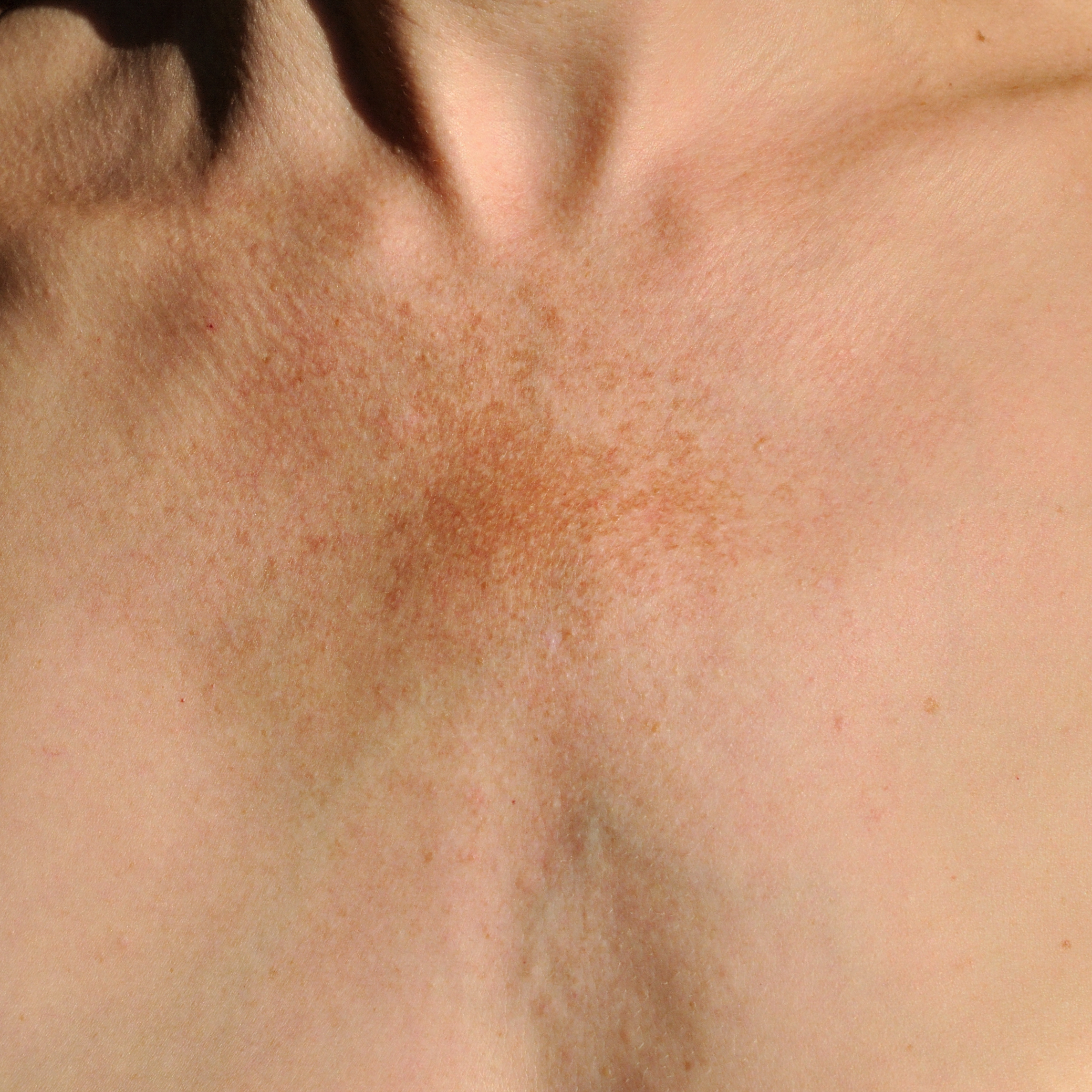 Melasma Service Photo2
