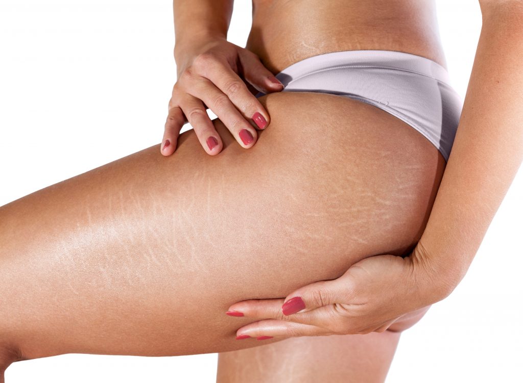 Stretch Marks  Advanced Dermatology, P.C.