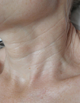 Intensif Microneedle Treatment patient after photo
