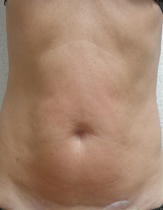 Intensif Microneedle Treatment patient after photo
