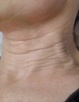 Intensif Microneedle Treatment patient before photo