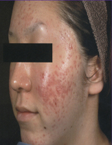 Intensif Microneedle Treatment patient before photo
