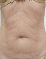Intensif Microneedle Treatment patient before photo