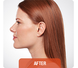 Kybella patient after photo
