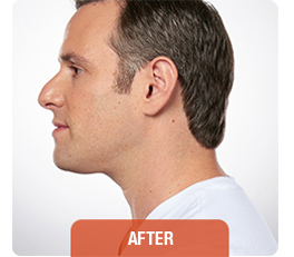 Kybella patient after photo