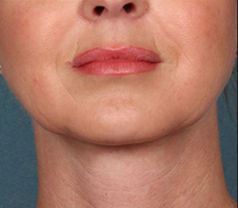 Kybella patient after photo