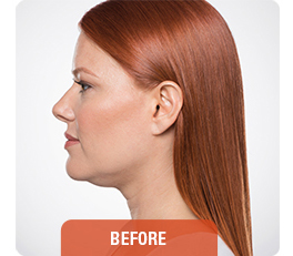 Kybella patient before photo