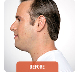 Kybella patient before photo