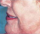 Laser Skin Resurfacing patient after photo