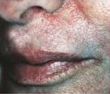 Laser Skin Resurfacing patient after photo