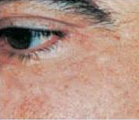 Laser Skin Resurfacing patient after photo