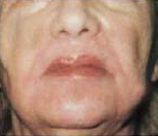 Laser Skin Resurfacing patient after photo