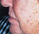 Laser Skin Resurfacing patient before photo