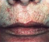 Laser Skin Resurfacing patient before photo