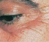 Laser Skin Resurfacing patient before photo