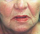 Laser Skin Resurfacing patient before photo