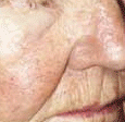 PDL VBeam patient after photo