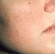 PDL VBeam patient after photo