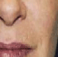 PDL VBeam patient after photo